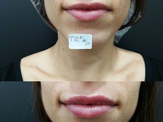 Antes y después Aumento de labios con ácido hialurónico