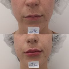 Antes y después Aumento labios con ácido hialurónico - Clínica Bedoya