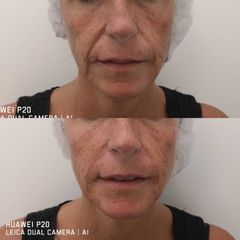 Antes y después Relleno nasolabial - Clínica Bedoya