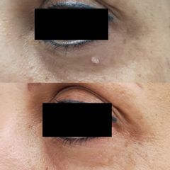 Antes y después Eliminación de verruga