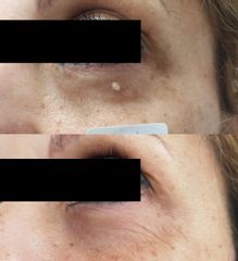 Antes y después Eliminación de verruga