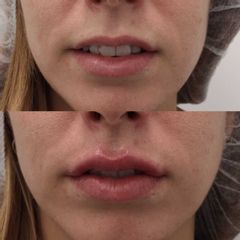 Antes y después Relleno de labios 
