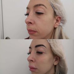 Antes y después  Eliminación de ojeras - Clínica Bedoya