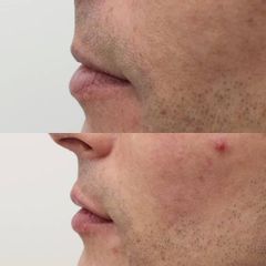 Antes y después Aumento de labios - Clínica Bedoya