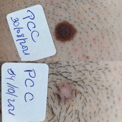 Nevus pigmentado, con Plexr - Clínica Bedoya