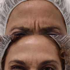 Tratamiento para las arrugas de expresión - Clínica Bedoya