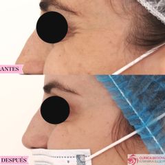 Eliminación de arrugas - Clínica Bedoya