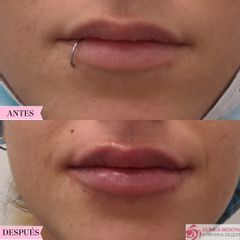 Relleno de labios con ácido hialurónico- clínica bedoya