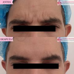 Tratamiento anti arrugas - Clínica Bedoya