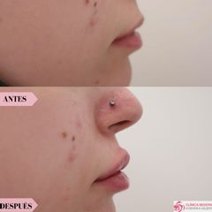 Aumento de labios - Clínica Bedoya