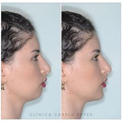 Antes y después Aumento de mentón - Clínica Varela Reyes