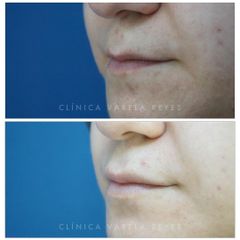 Antes y después Aumento de labios - Clínica Varela Reyes