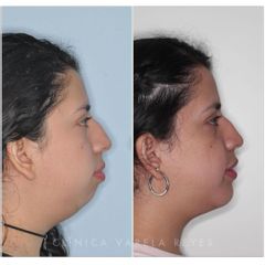 Antes y después Bichectomía - Clínica Varela Reyes