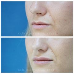 Antes y después Aumento de labios - Clínica Varela Reyes