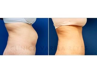 Antes y después Abdominoplastia - Clínica Varela Reyes