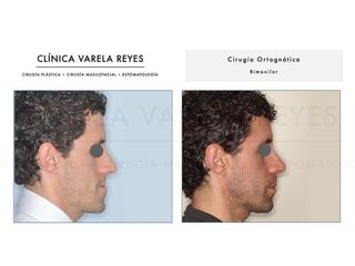 Antes y después Cirugía maxilofacial - Clínica Varela Reyes