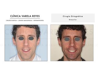 Antes y después Cirugía maxilofacial - Clínica Varela Reyes