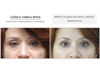 Antes y después Eliminación de ojeras - Clínica Varela Reyes