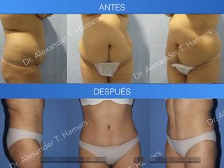 Antes y después Abdominoplastia