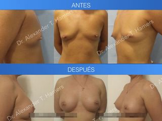 Antes y después Aumento de mamas combinado