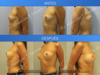 Antes y después Aumento de mamas combinado