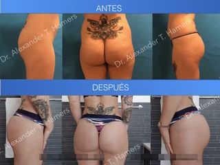 Antes y después Lipoescultura