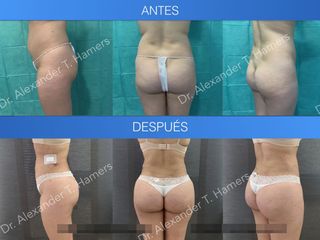 Antes y después Lipoescultura