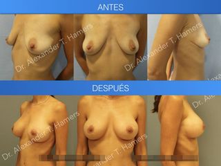Antes y después Mastopexia