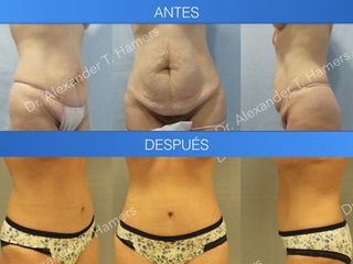Antes y después Abdominoplastia