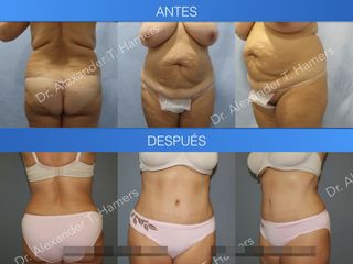 Antes y después Abdominoplastia