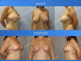 Antes y después Reducción Mamaria