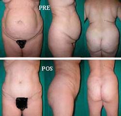 Abdominoplastia y liposucción - Dr. José Luis Diaz Infante