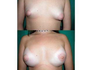 Mamas Tuberosas Asimetría - Dr. José Luis Diaz Infante