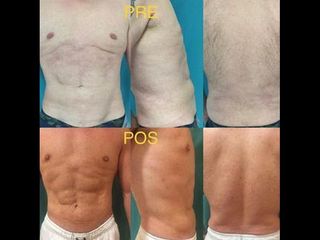 Lipo HD - Dr. José Luis Díaz Infante