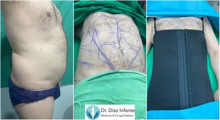 Lipoláser - Dr. José Luis Díaz Infante