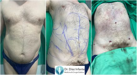 Lipoláser - Dr. José Luis Díaz Infante
