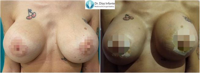 Aumento de pecho - Dr. José Luis Díaz Infante