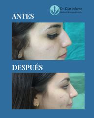 Rinoplastia - Dr. José Luis Díaz Infante