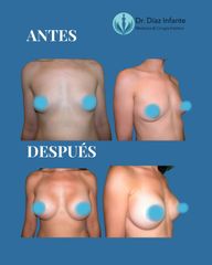 Aumento de pecho - Dr. José Luis Díaz Infante