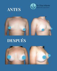 Aumento de pecho - Dr. José Luis Díaz Infante