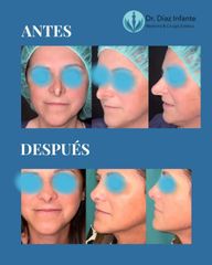 Rinoplastia secundaria