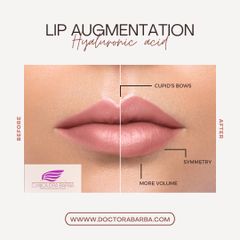 Aumento de labios