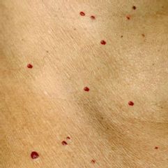 Lesiones de la piel por angiomas