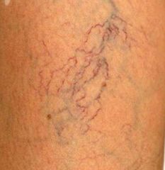 Tratamiento de varices, arañas vasculares , telangiectasias y variculas
