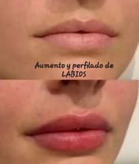 Aumento de labios - Doctora Barba Martínez