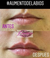 Aumento de labios - Doctora Barba Martínez