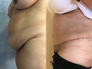 Abdominoplastia - Dra. Banacu Luminita