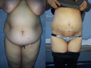 Abdominoplastia - Dra. Banacu Luminita