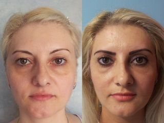 Blefaroplastia - Dra. Banacu Luminita