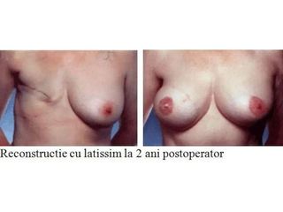 Reconstructia de san